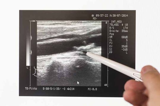 carotis sonographie